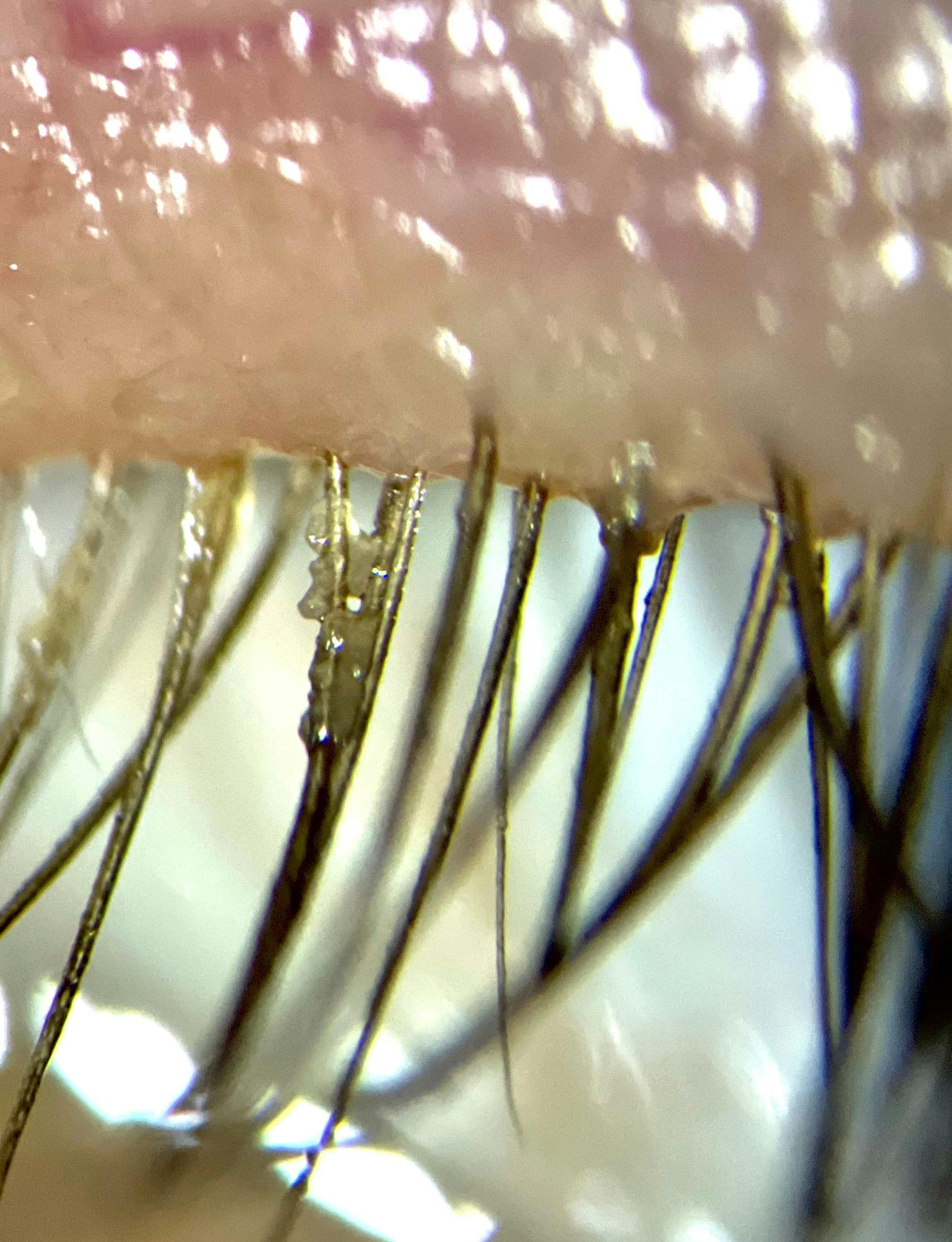 Demodex Mites on Lash Margin