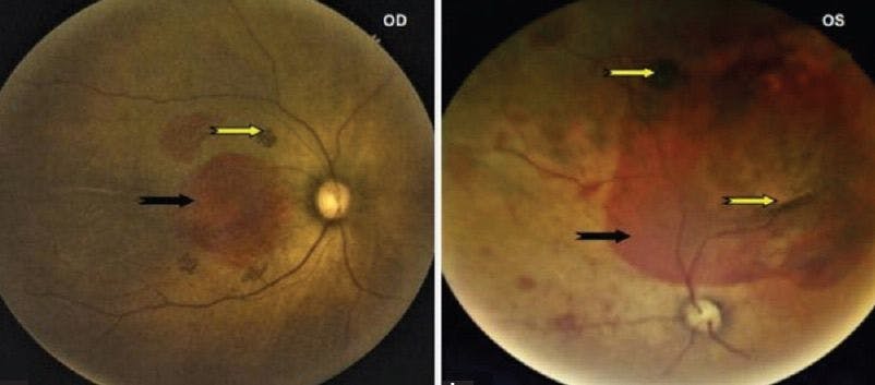 Chorioretinitis and CMV 4 Week Old Infant