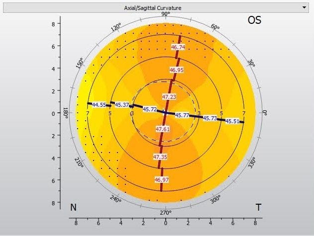 Corneal topography of WTR astigmatism