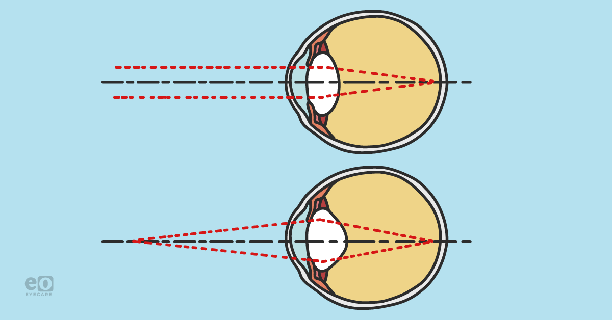 Clinical Signs Suggesting Near Point Stress and Risk of Myopic Progression