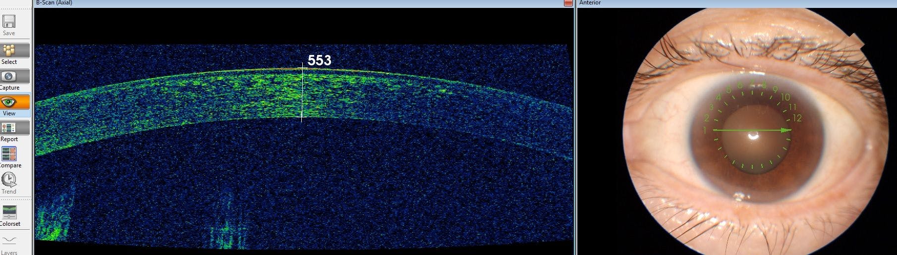 pachymetry reading