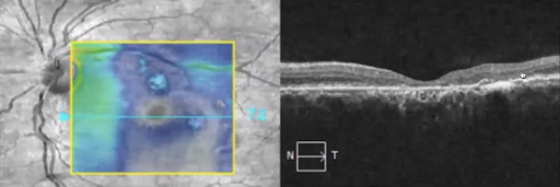 Fundus photo and OCT macula