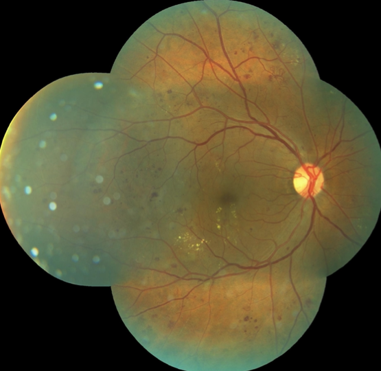 Proliferative Diabetic Retinopathy Fundus Image - 51yo female patient