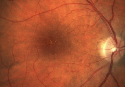 Color fundus photograph (CFP) of the patient's right eye from 12 years ago, showing the presence of drusen.