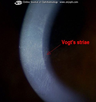 Vogt's Striae