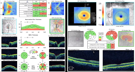 Ganglion Cell Analysis