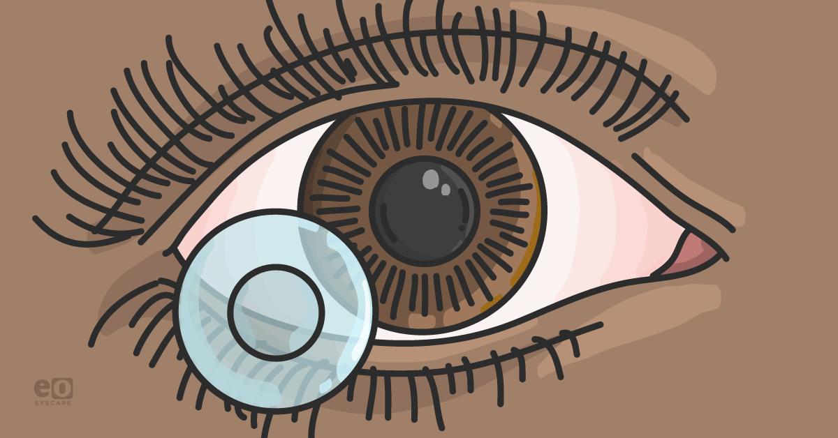 Treating Corneal Dellen with Bandage Contact Lenses