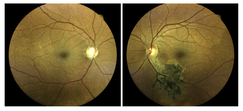 Dilated Fundus