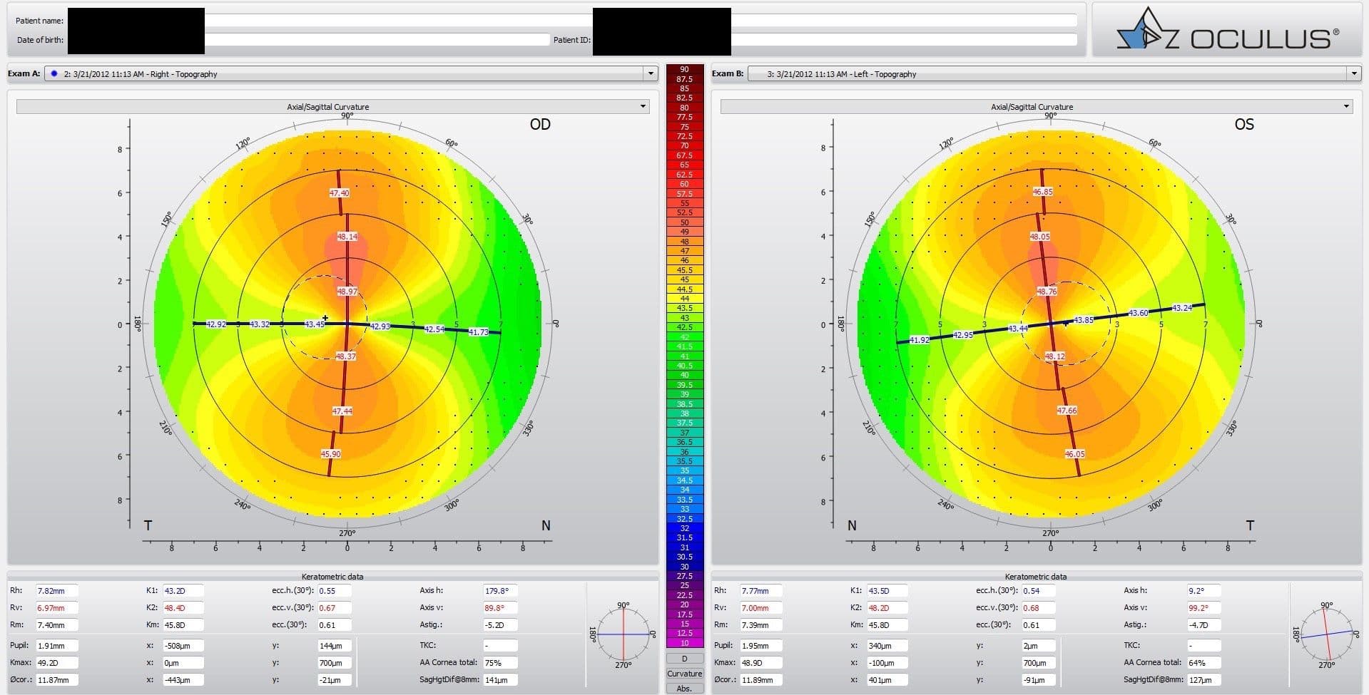 oculus imaging of astigmatism