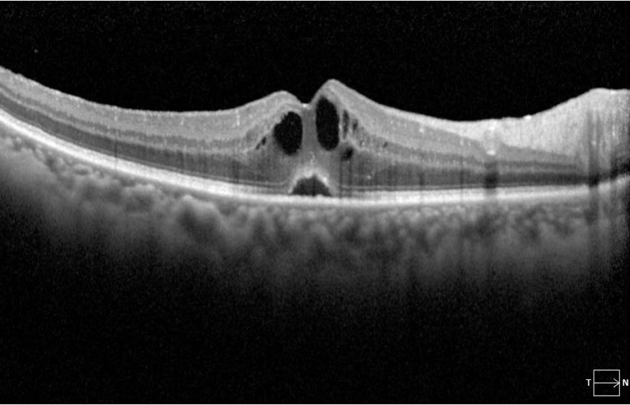 OCT Cystoid Macular Edema