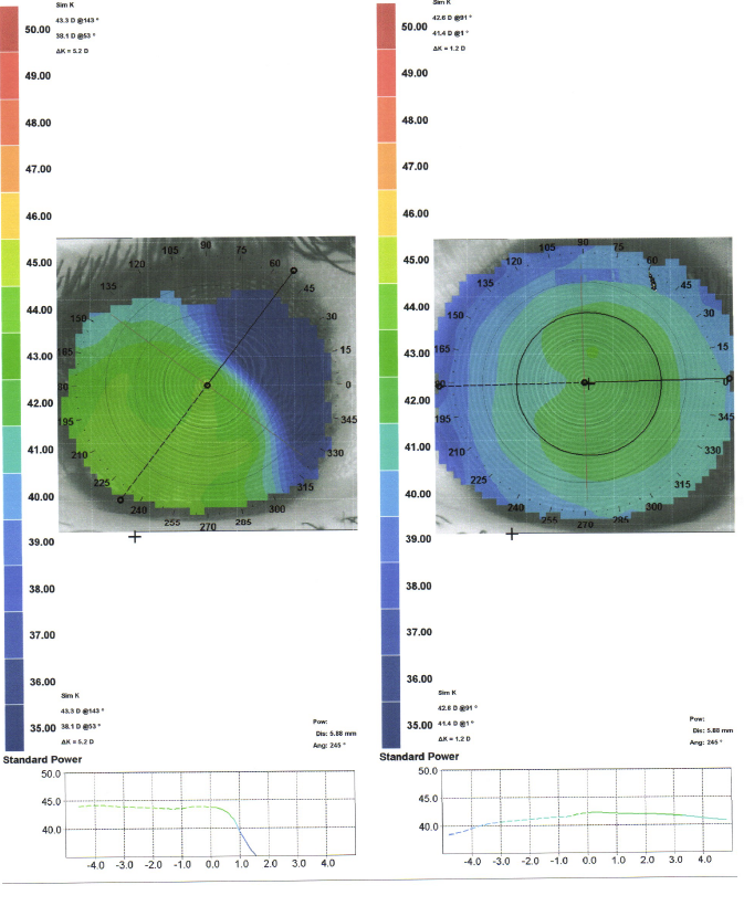 Topography microcornea 2012