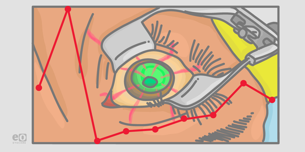 Managing IOP Spikes After Cataract Surgery