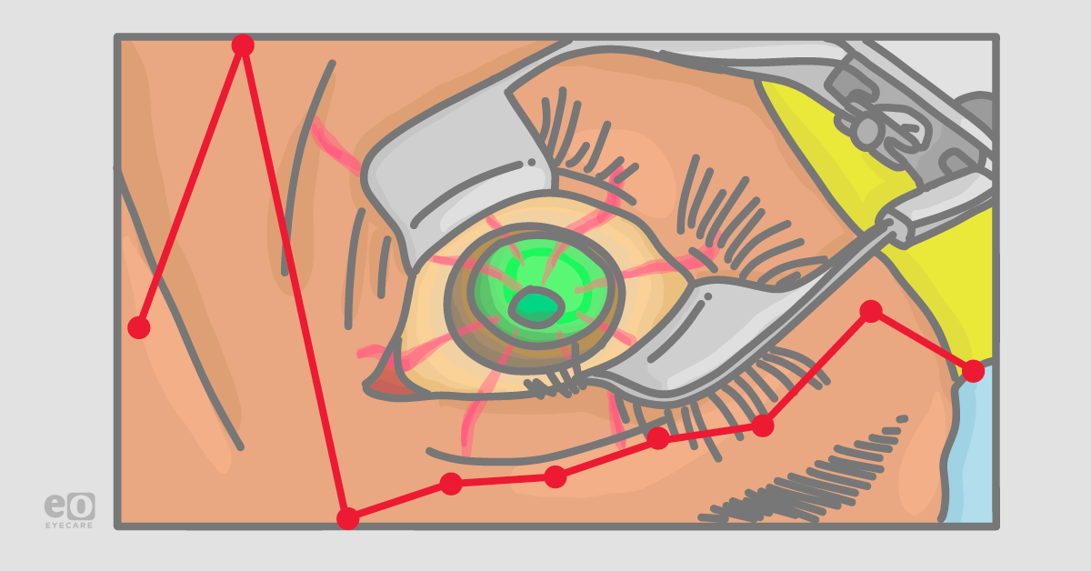 Managing IOP Spikes After Cataract Surgery