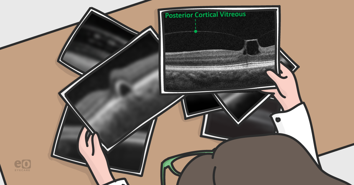 How to Spot Vitreomacular Traction