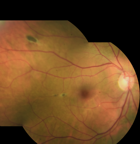 RPE hamartomas associated with familial adenomatous polyposis 1