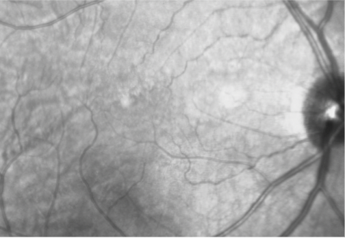 Near-infrared reflectance (NIR) imaging of the patient's right eye from 12 years ago, showing a relatively health retina.