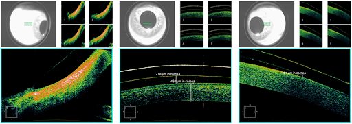 Anterior Segment OCT