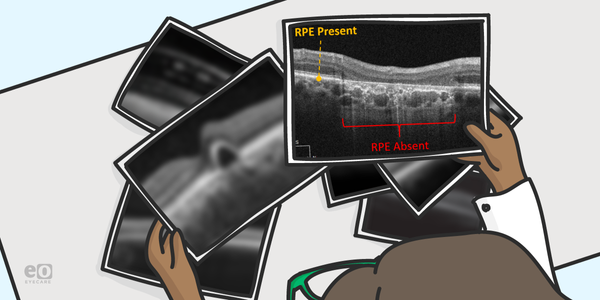 Age-Related Macular Degeneration: A Preamble