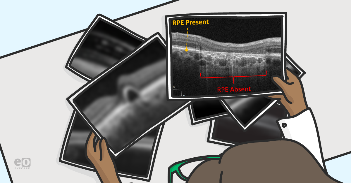 Age-Related Macular Degeneration: A Preamble