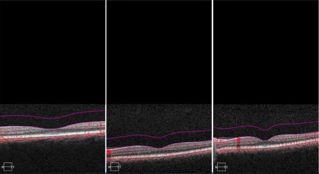 OCTA vitreoretinal interface slab view