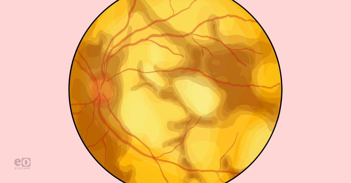 5 Things Ophthalmologists Should Know About Ocular Oncology in 2023