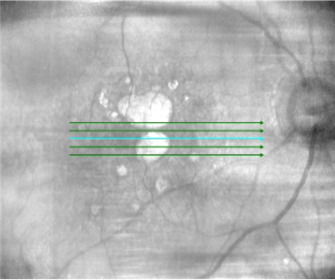 Line scanning ophthalmoscope OCT GA