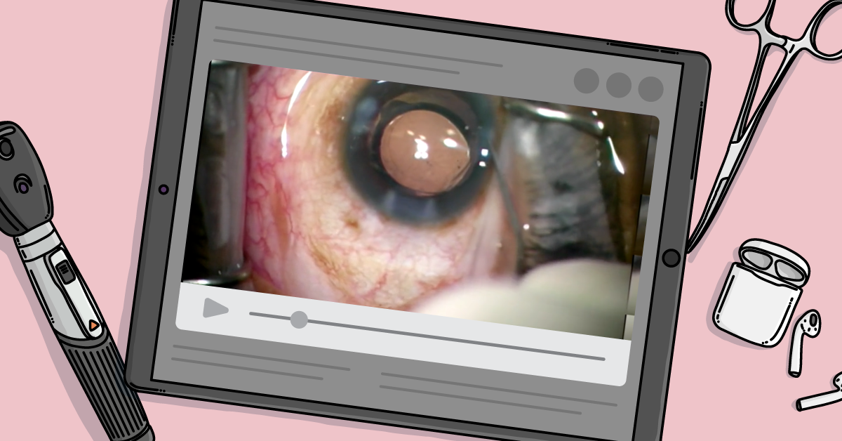 Dexycu Intravitreal Implantation