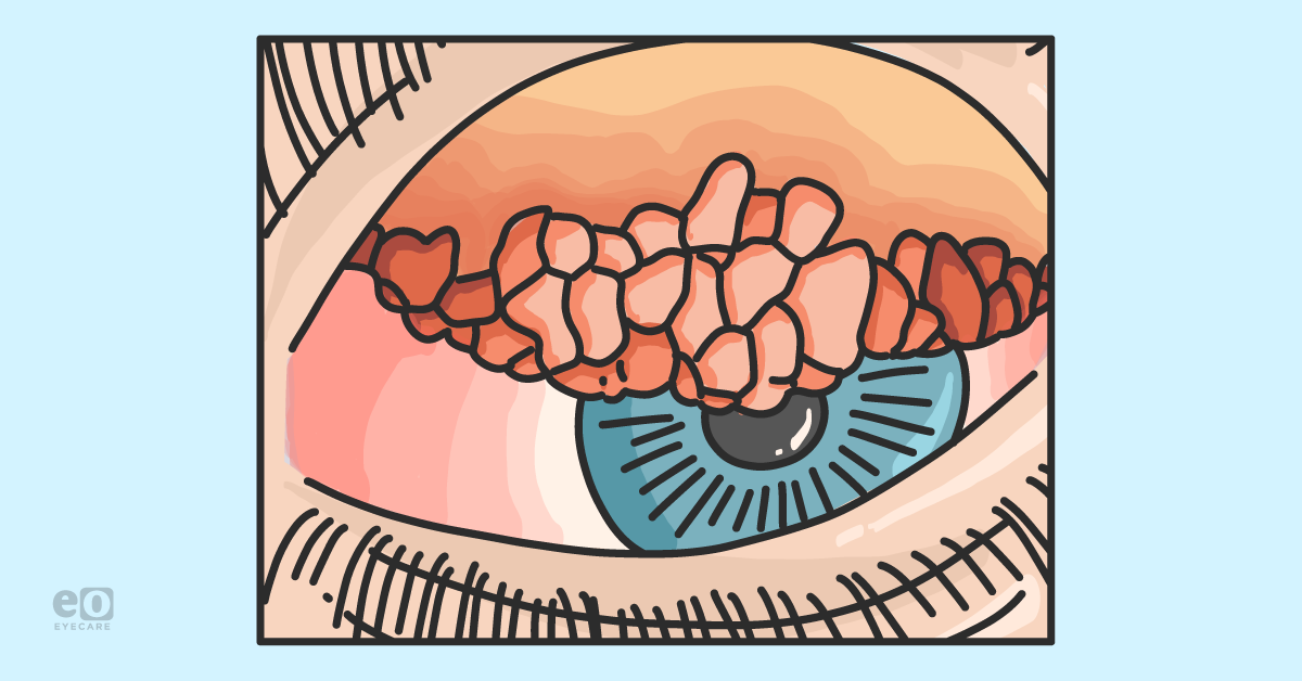 Managing Vernal Keratoconjunctivitis