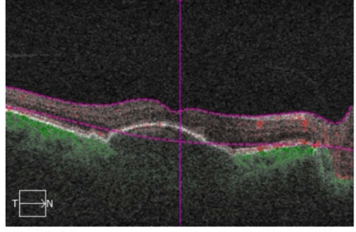 Flow overlay Dry AMD with drusenoid PED