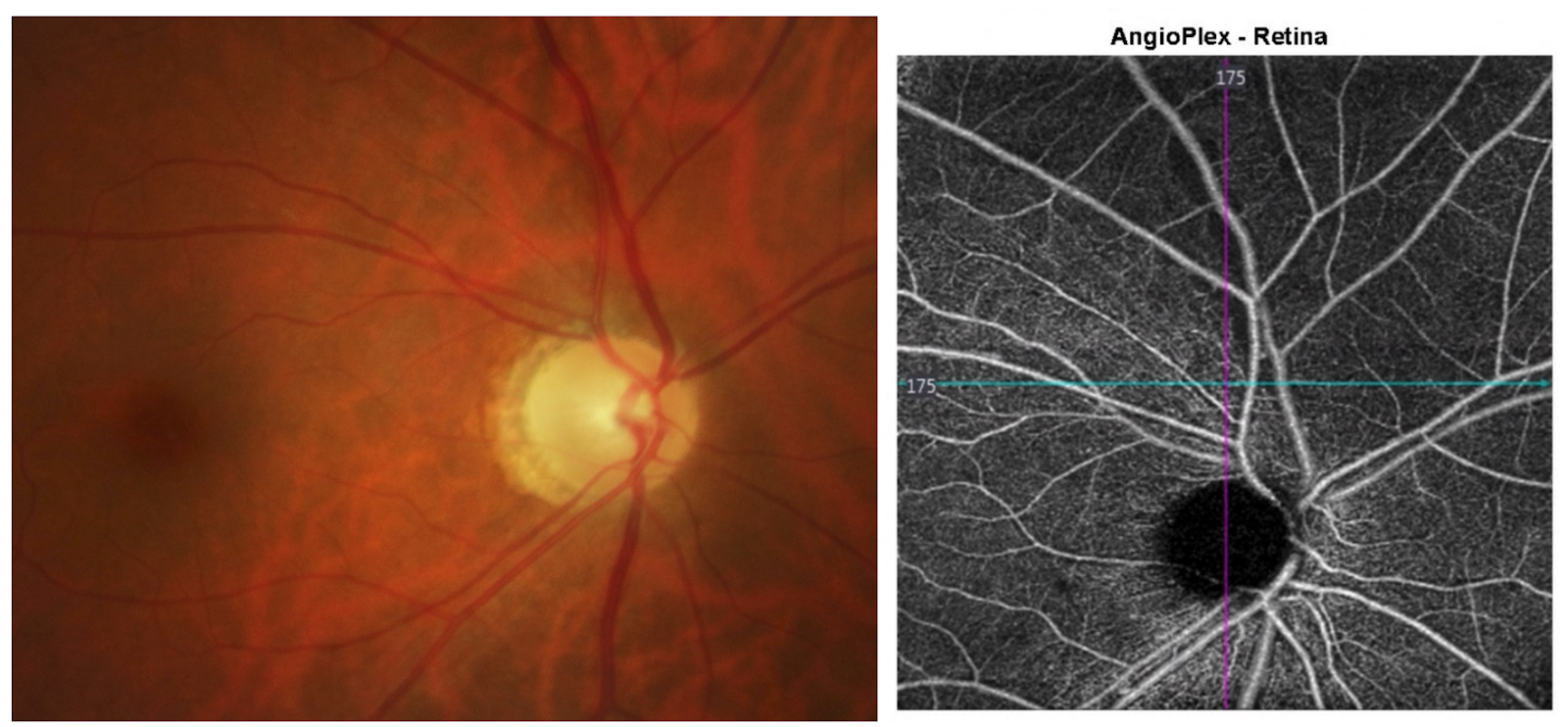 Vessel density - Unexplained pallor