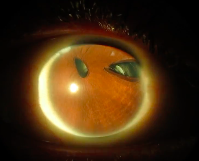 Microcornea