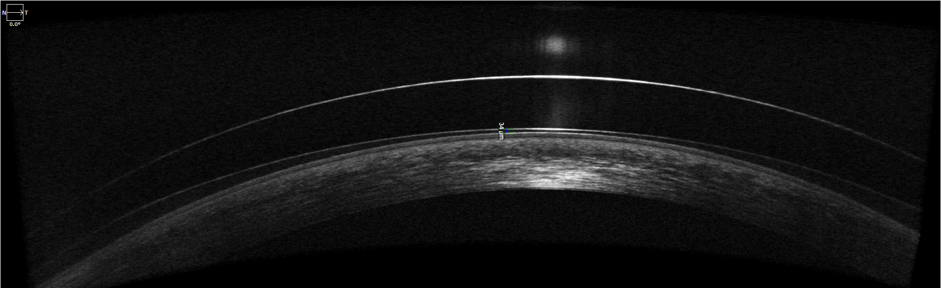 Scleral lens distortion