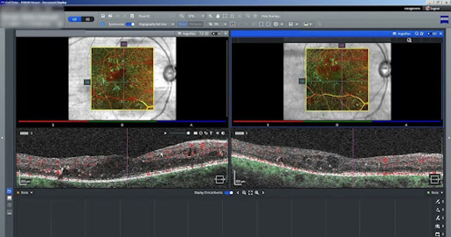 OCTA imaging of macular ischemia