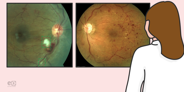 A Resident's Guide to Diabetic Retinopathy Surgical Treatment Options