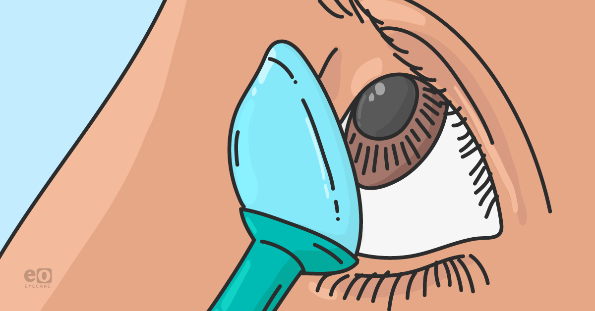 When Distorted Vision Happens: Troubleshooting the Scleral Fit