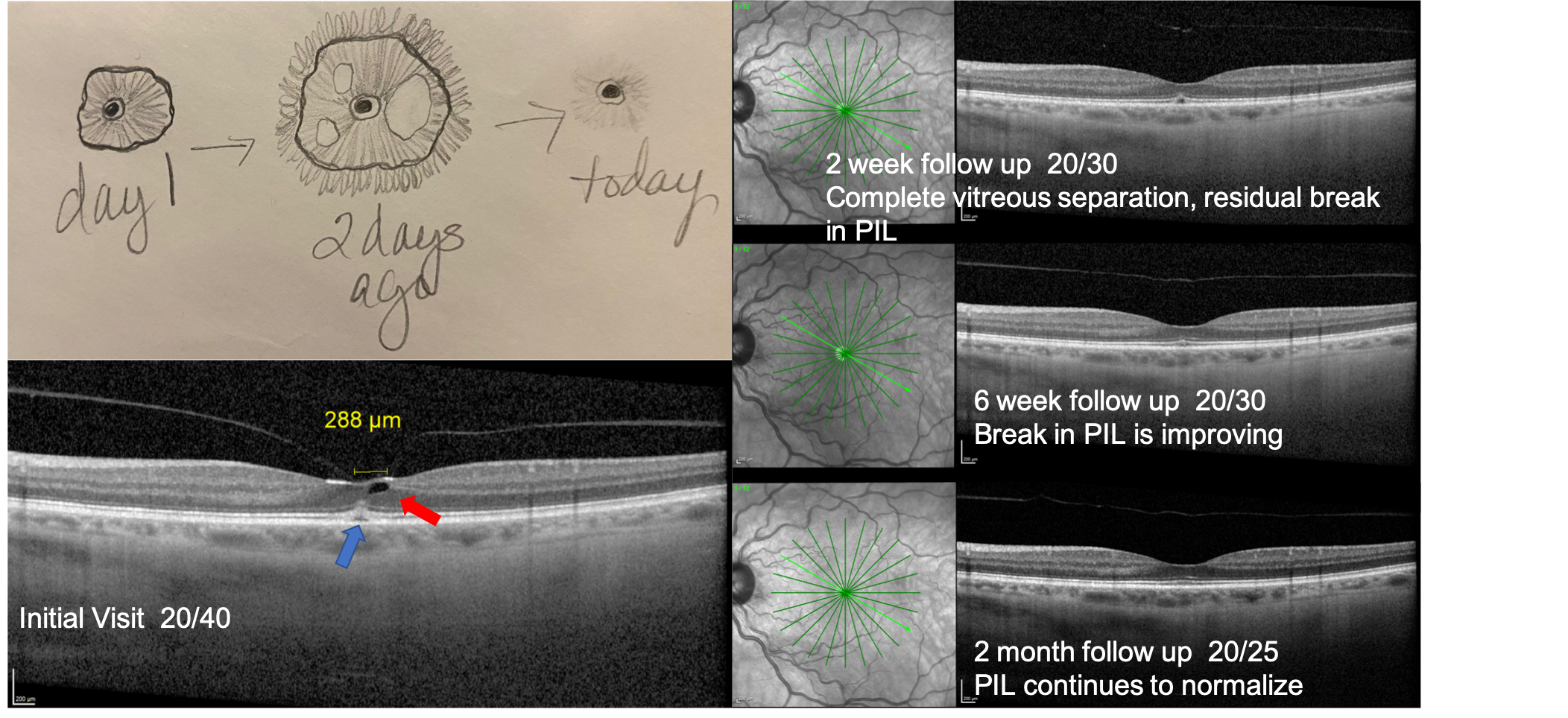 Vitreomacular Traction OCT Imaging