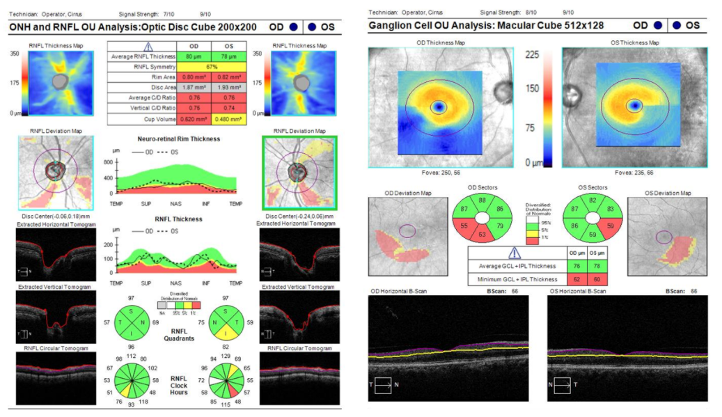 OCT RNFL Macula thinning