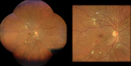 OCT-A Regions Nonperfusion