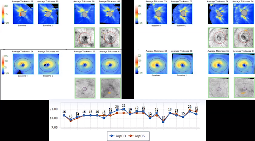 Nerve Fiber Layer Analysis