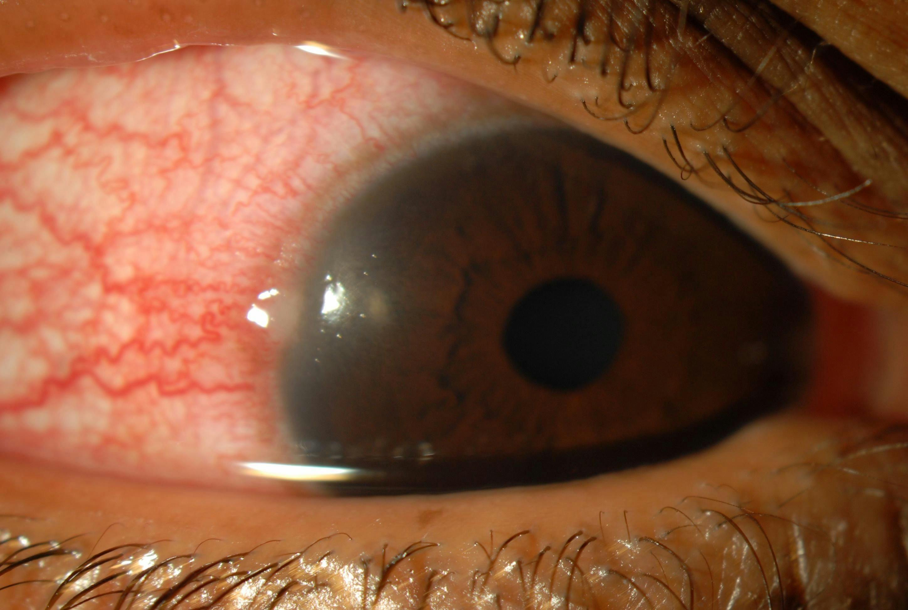 Phlyctenular keratoconjunctivitis slit lamp