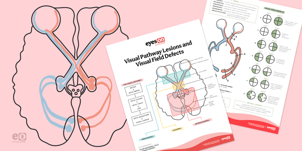 Visual Pathway Lesions and Corresponding Visual Field Defects with Download