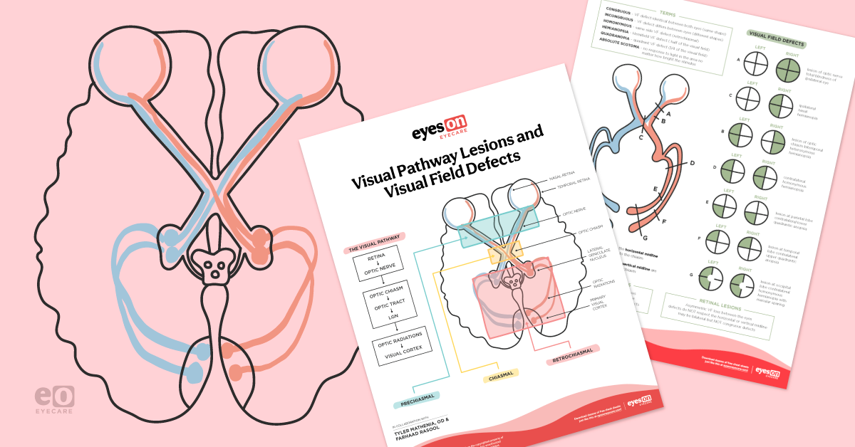 Visual Pathway Lesions and Corresponding Visual Field Defects with Download