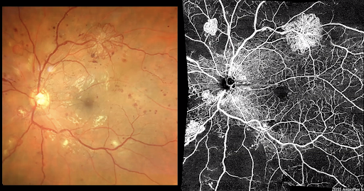 Large Regions of Nonperfusion