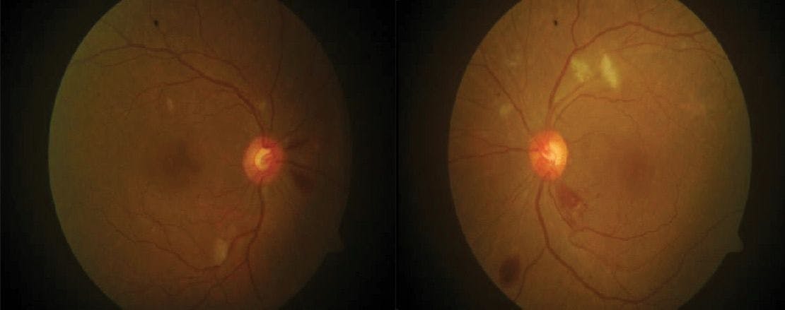 Hypertensive Retinopathy Secondary to Preeclampsia