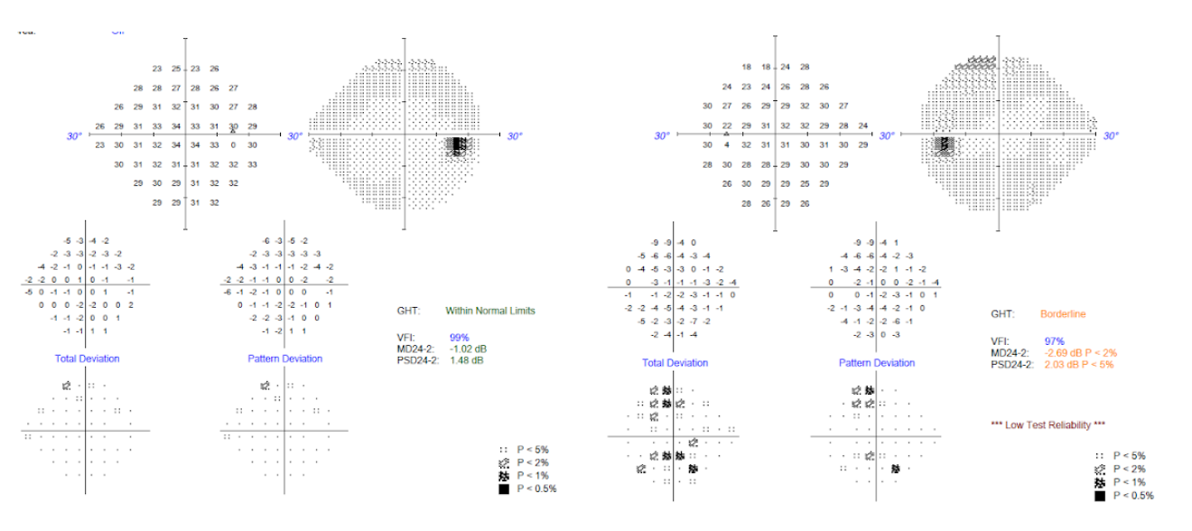 Visual Field Exam 1.png