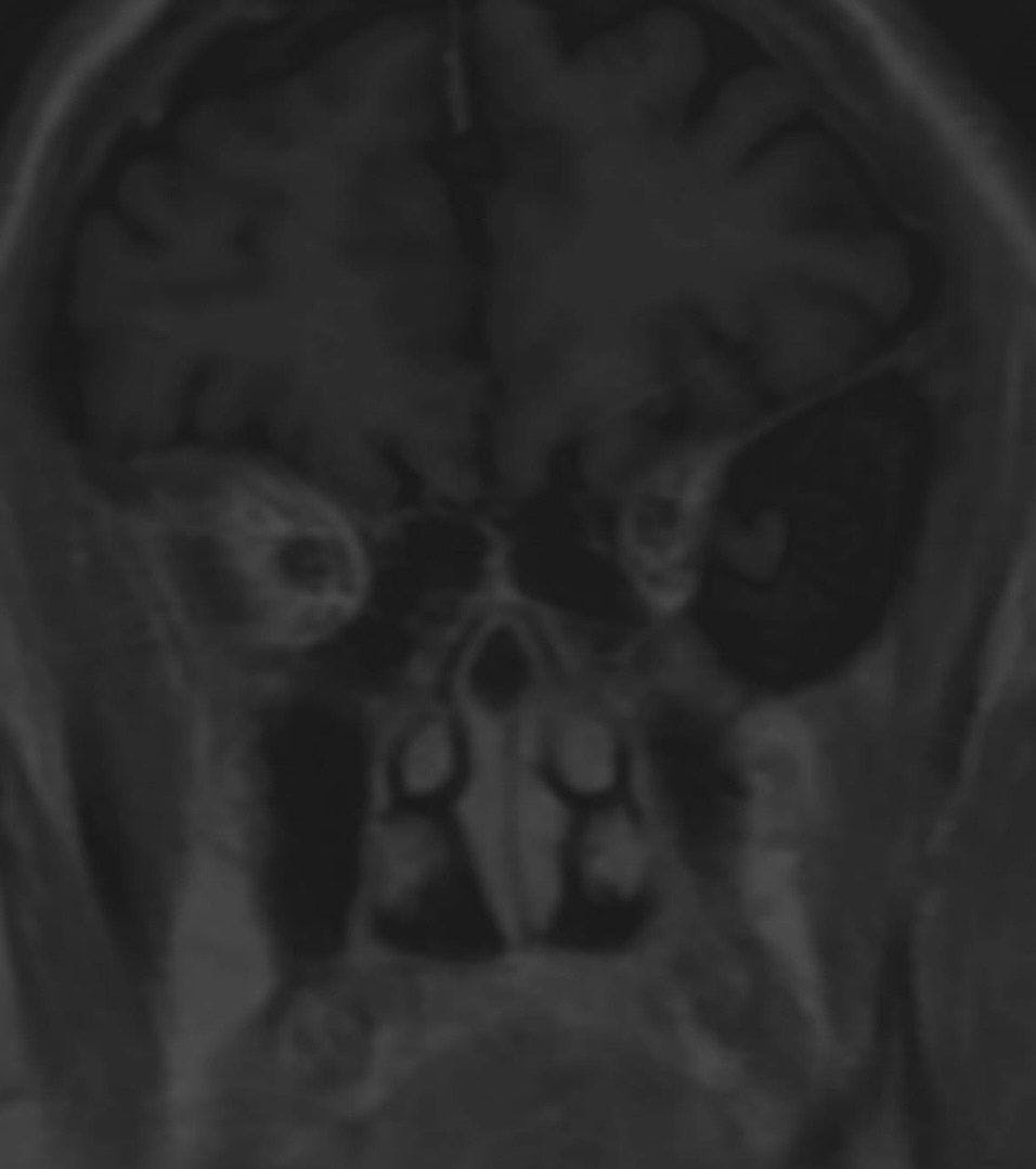 Brain MRI