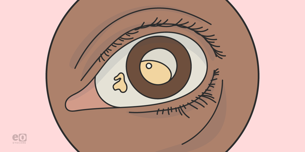 Case Report: Morgagnian Cataract