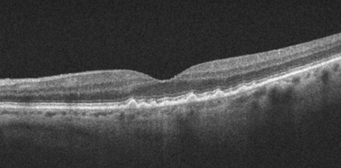 Baseline OCT OS