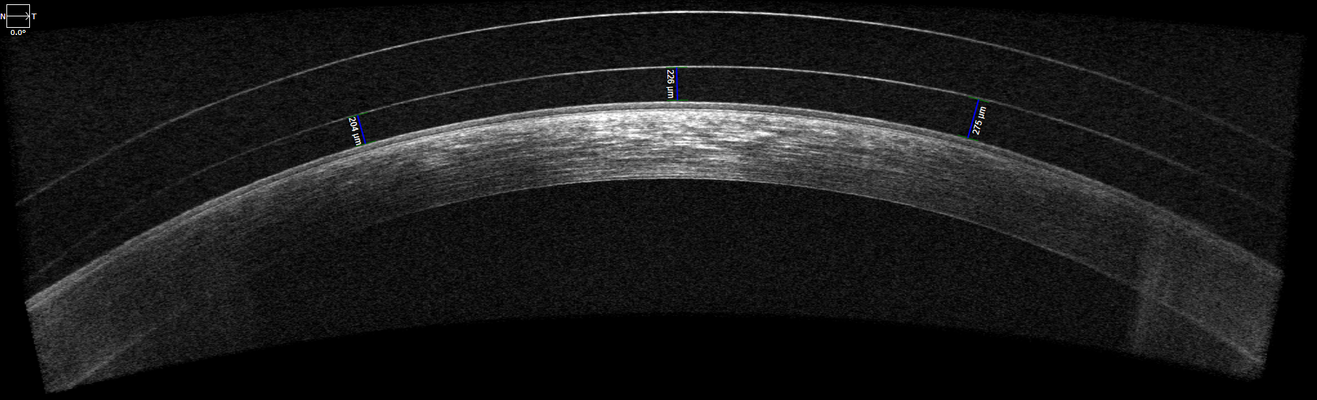 Scleral lens distortion