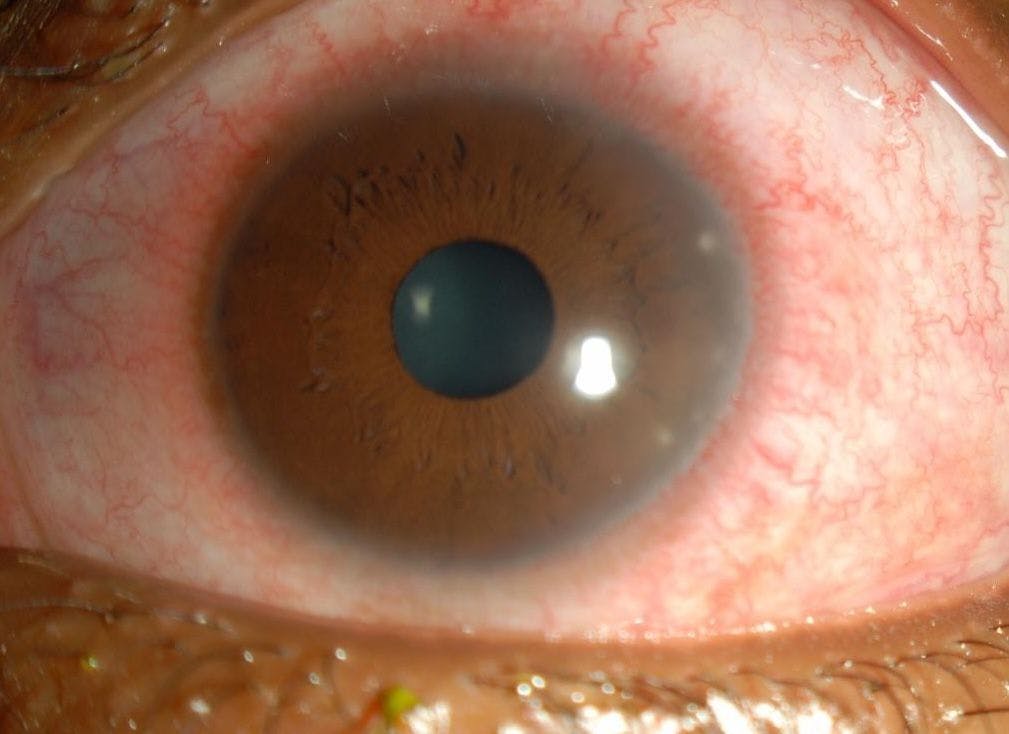 Marginal keratitis slit lamp